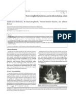 Cardiac Involvement in Non-Hodgkin Lymphoma, An Incidental Large Atrial Mass: A Case Report