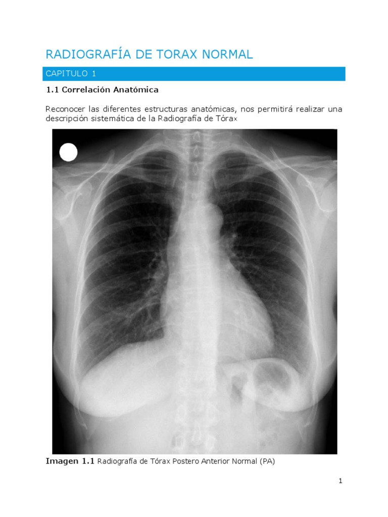 Radiografía de Tórax Normal: Guía Visual | PDF | Tórax | Pulmón