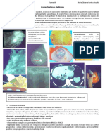 Carcinoma Ductal Invasor de Mama