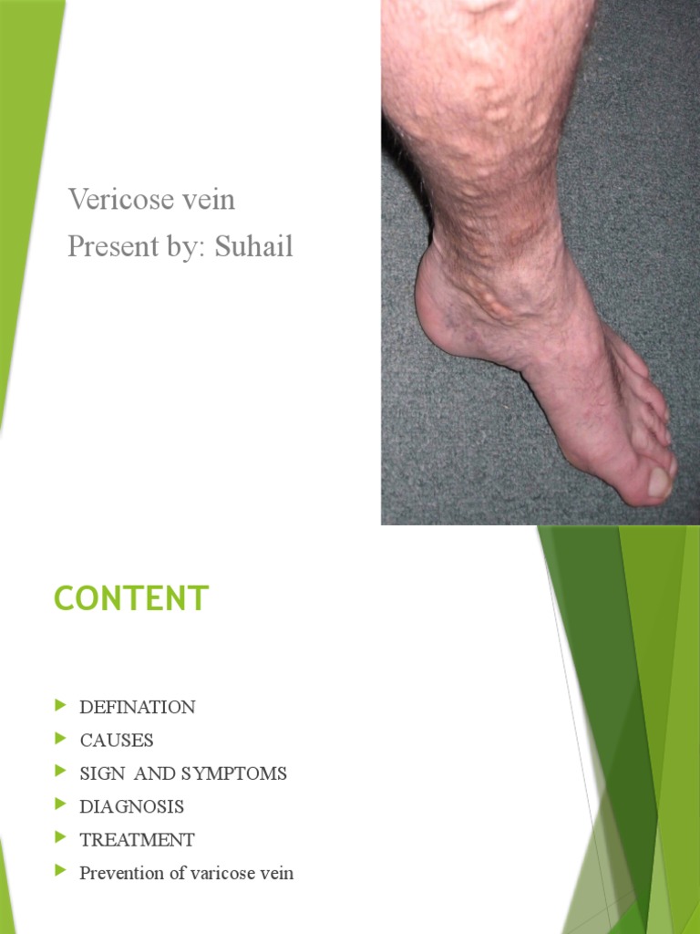 Vericose Vein WPS Office PDF Varicose Veins Medical Specialties