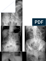 Oclusion intestinal