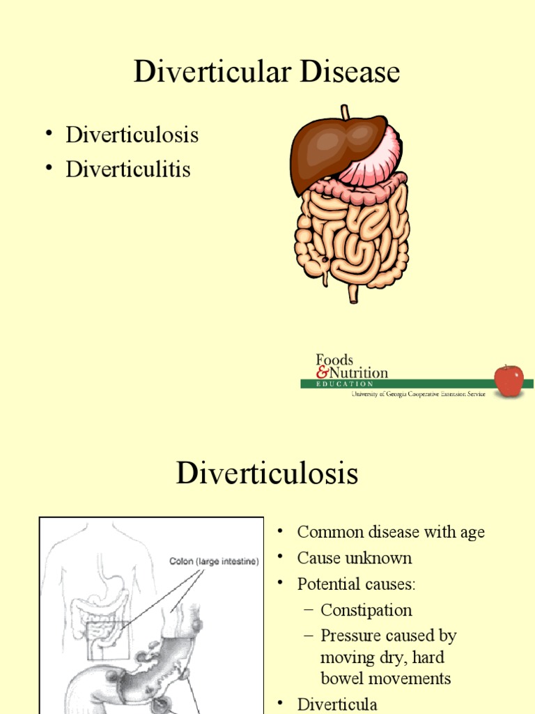 Diverticular Disease Diverticulosis Diverticulitis PDF