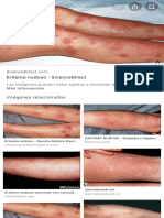 eritema nodoso - Búsqueda de Google