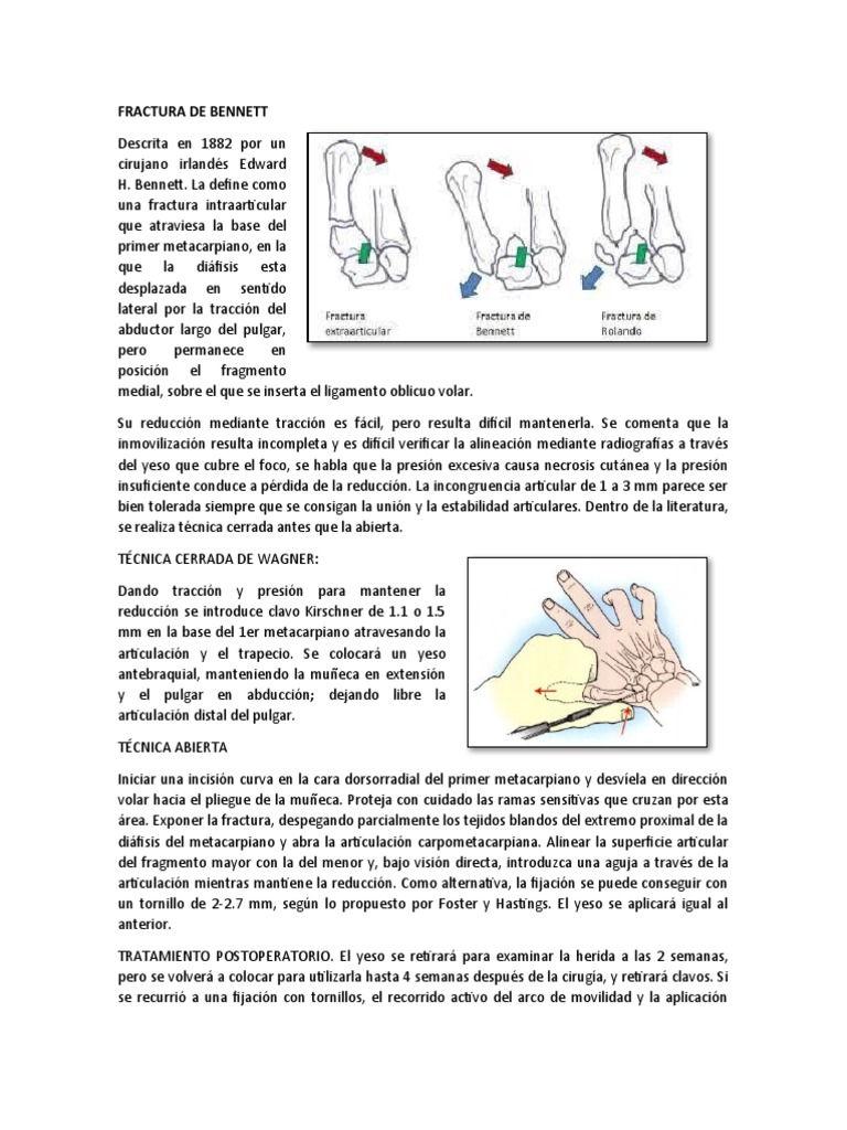 FRACTURA DE BENNETT y ROLANDO | PDF | Fractura | Sistema esquelético