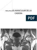 Necrosis Avascular de La Cadera