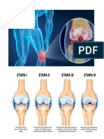 Fibromialgia y Artrosis