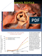 Estenosis Aortica