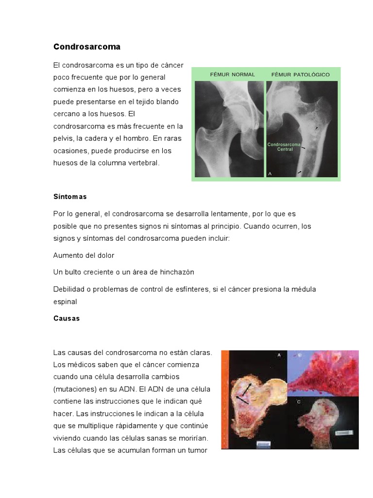 Condrosarcoma | PDF | Cáncer | Terapia de radiación