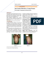 A Case of Giant Uterine Fibroid in A Toung Woman