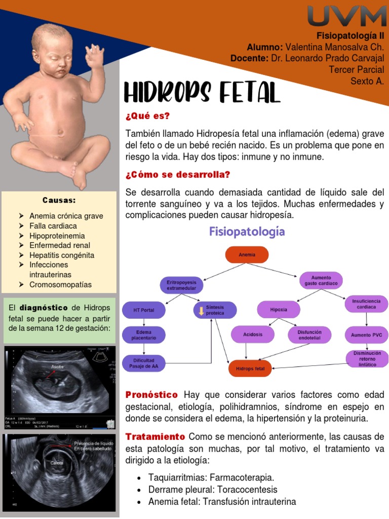 Hidropesía Fetal: Causas y Tratamiento | PDF
