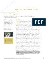 Intramedullary Nail Fixation of Tibial Shaft Fractures