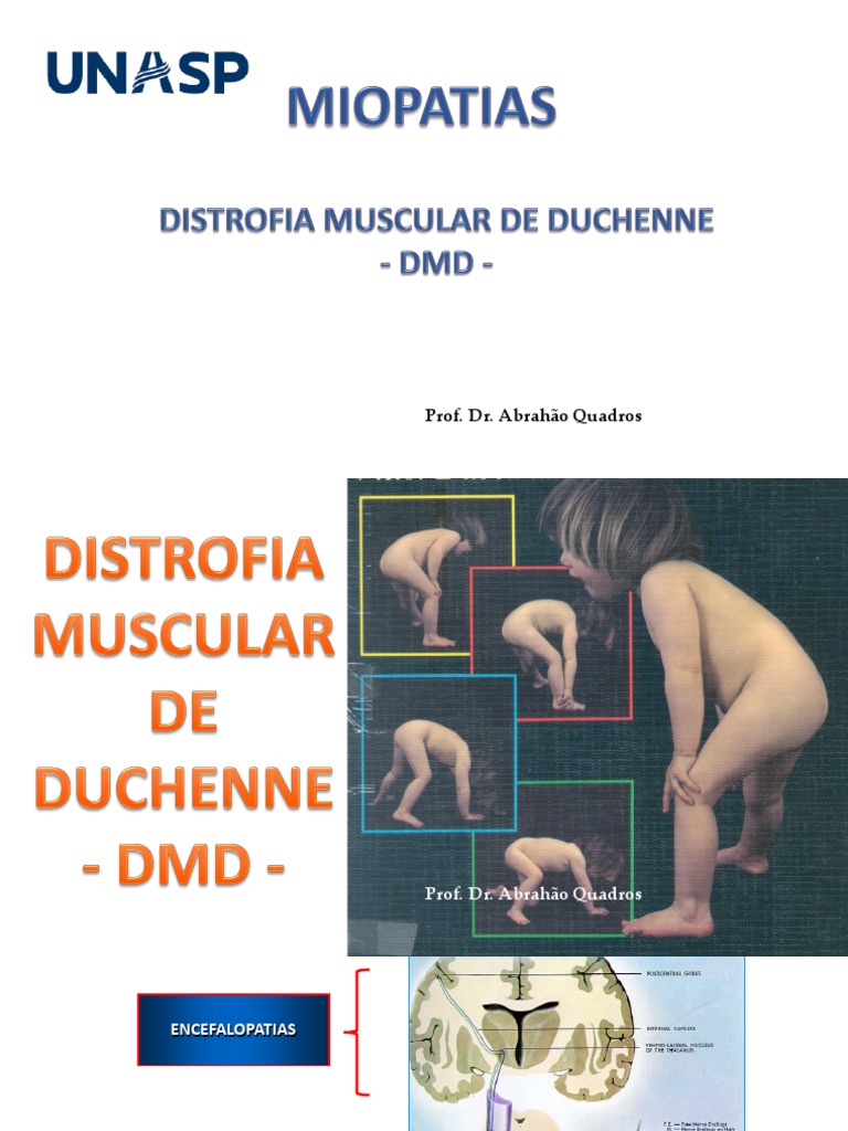Distrofia Muscular de Duchenne: Aspectos Clínicos | PDF | Distrofia ...