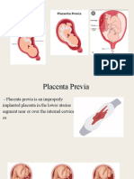 Placenta Previa Abruptio Placenta