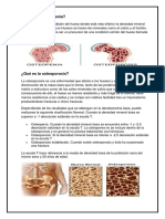 Que Es La Osteopenia