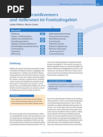 Adhäsive Keramikveneers Und Teilkronen