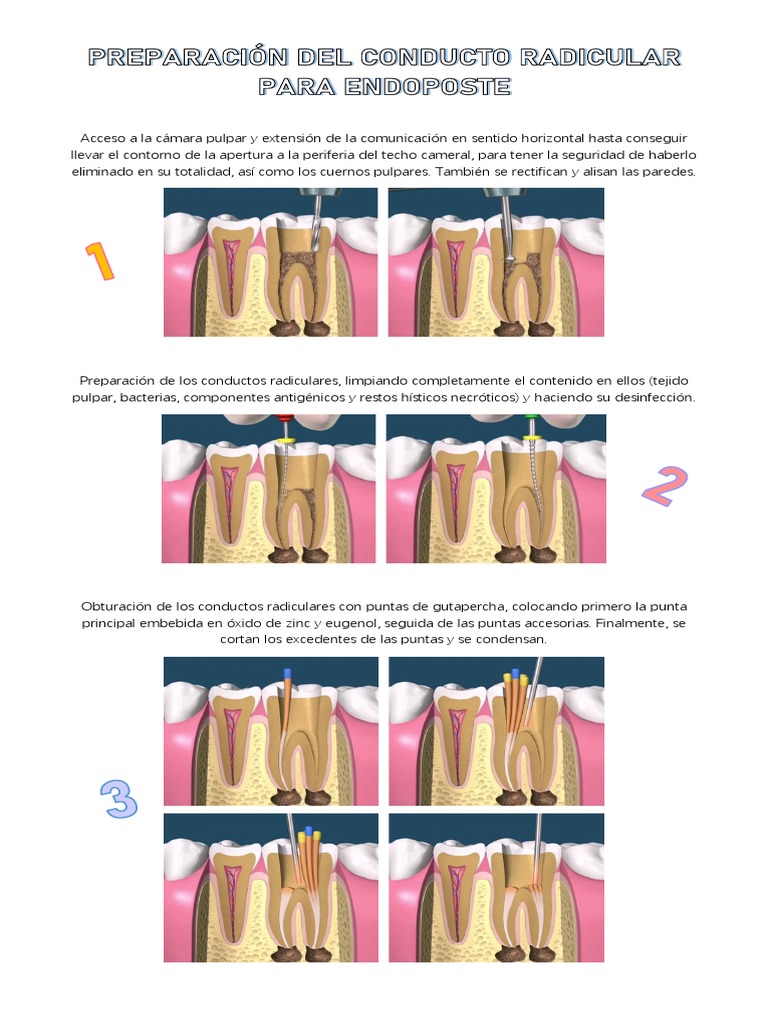 Preparación para Endoposte | PDF | Anatomia dental | Boca
