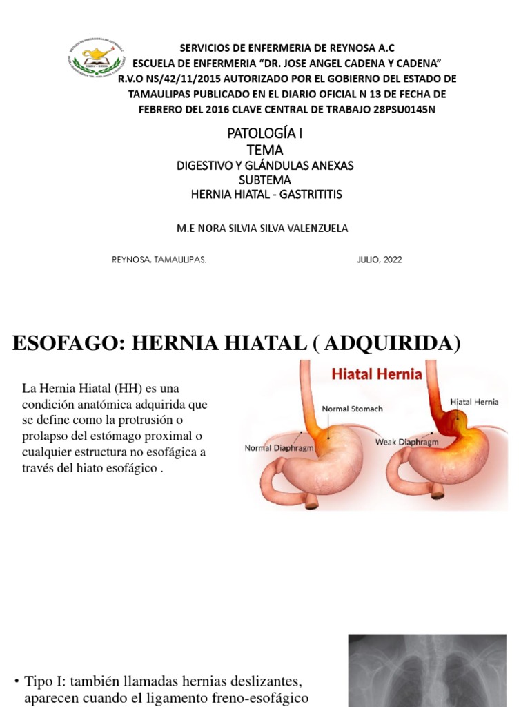 Tema Hernia Hiatal Pdf La Enfermedad Por Reflujo Gastroesofágico