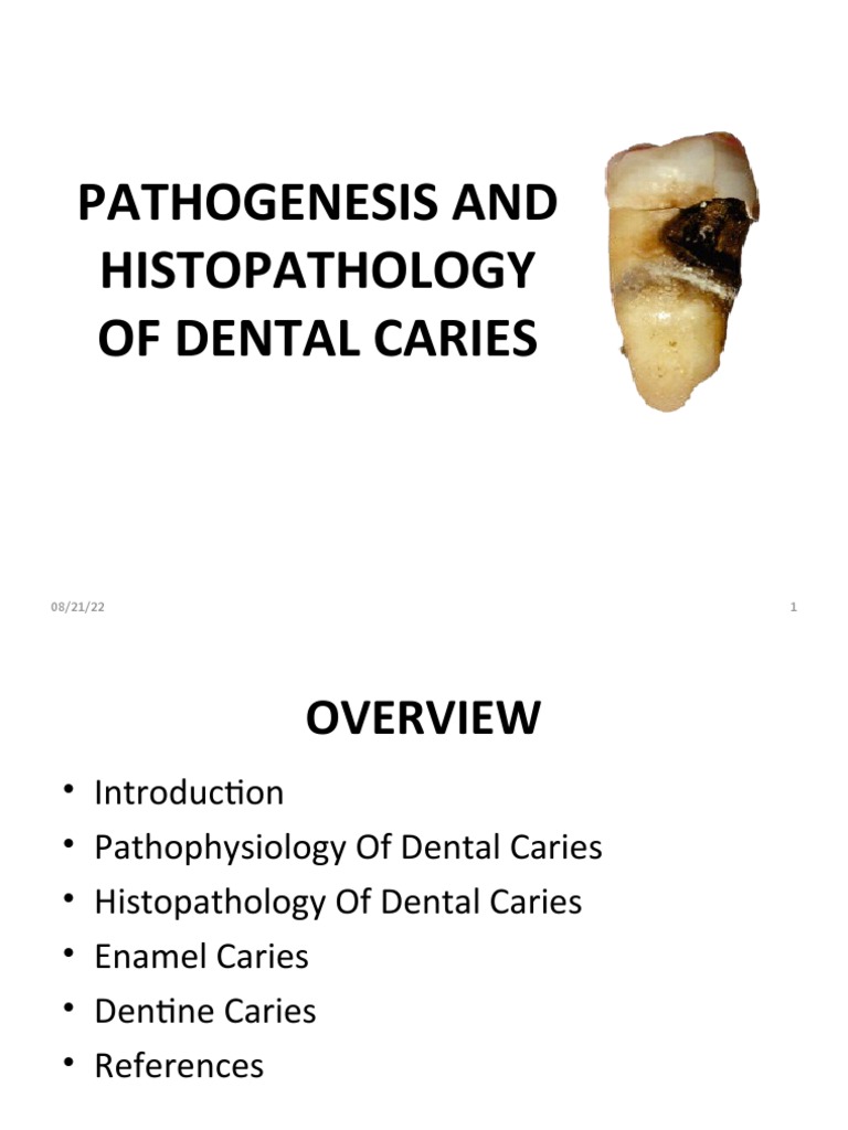 Histopathology of Dental Caries | PDF | Tooth Enamel | Dentin