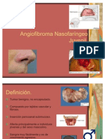 Angiofibroma Nasofaríngeo Juvenil