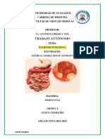 Poliposis Intestinal-Jinsop Gamboa