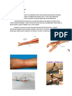 ACT Epidemiologia Enfermedad de de Quervain