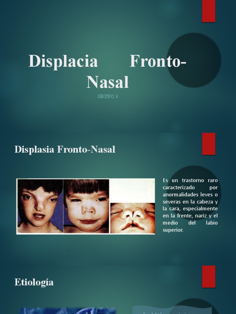 Displacia Fronto Nasal PDF Mutación Medicina CLINICA