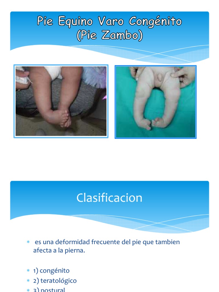 Pie Equino Varo Congénito