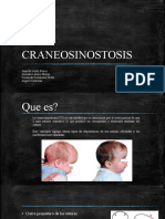 CRANEOSINOSTOSIS