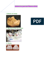 PPR (Prostodoncia Parcial Removible) : Proceso