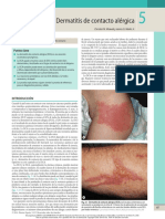 Dermatitis Contacto Alérgica