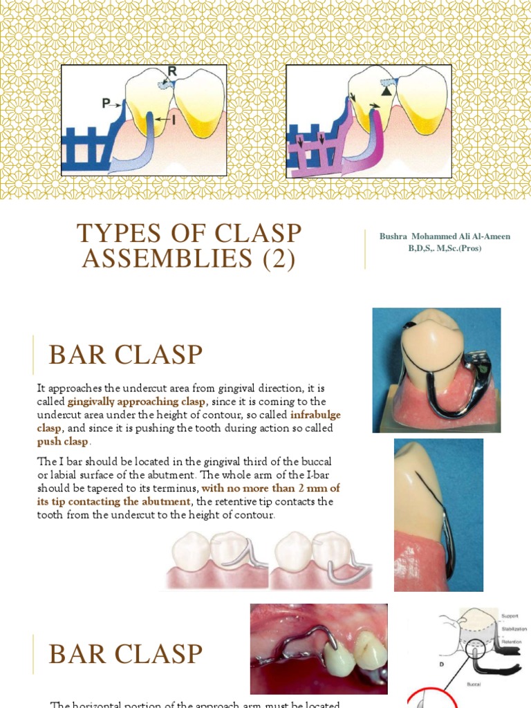 12) Types of Clasp Assemblies (2) PDF Dentistry Branches