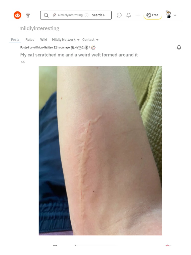 My Cat Scratched Me and A Weird Welt Formed Around It Mildlyinteresting PDF