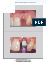 Minimally Invasive Extraction and Immediate Implant Placement The Preservation of Esthetics JPRD 2 06 ES