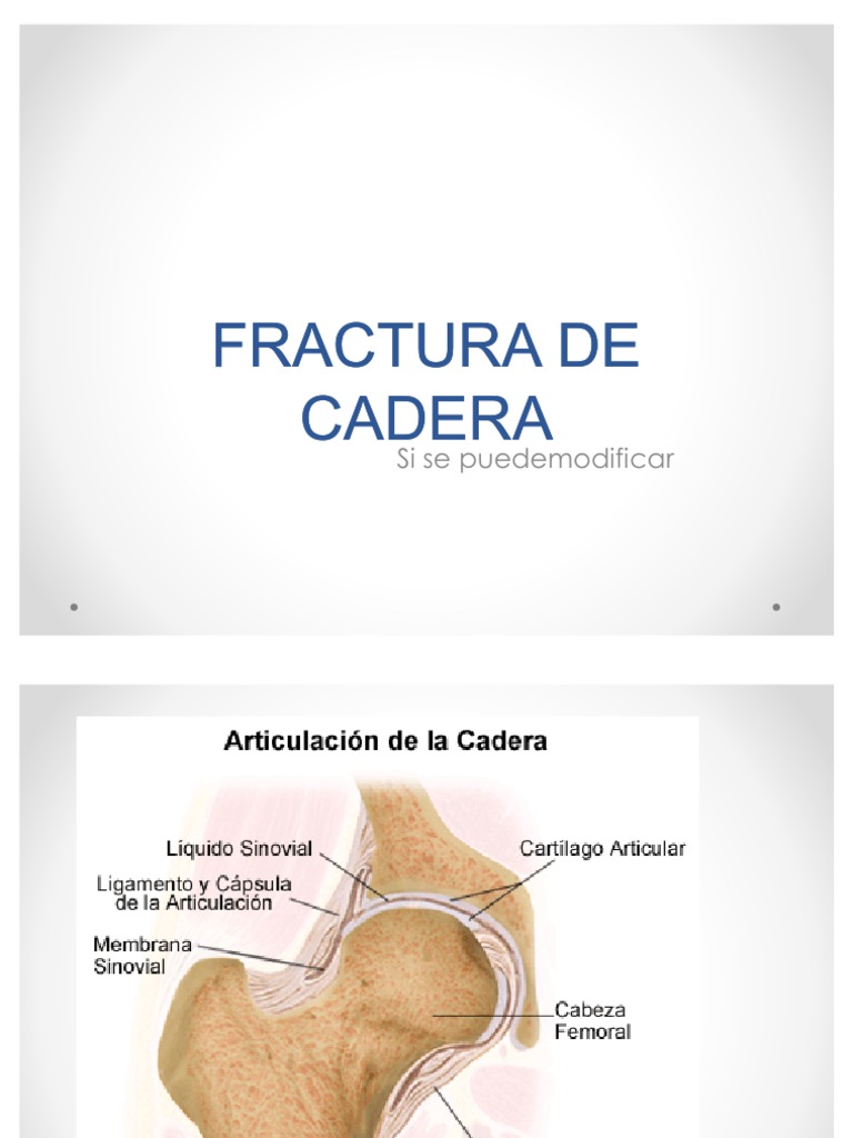 Fractura de Cadera | PDF | Cadera | Sistema musculoesquelético