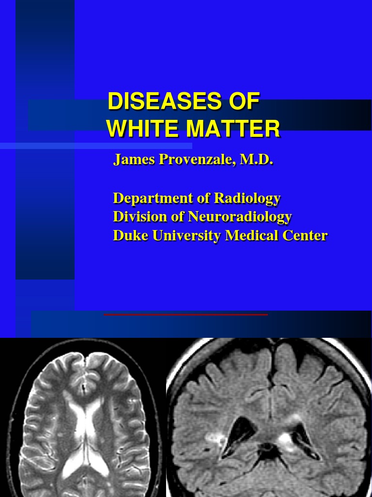 28 White Matter Diseases PDF Multiple Sclerosis Myelin
