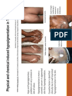 Physical and Chemical Induced Hypopigmentation in Type v Skin