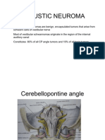 Acoustic Neuroma