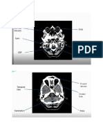 CT Scan