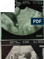 Ascitis Fetal