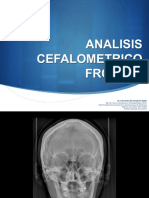 Analisis Cefalométrico Frontal