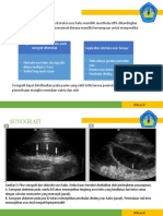 ILEUS