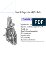 Critérios Diagnósticos das Taquicardias de QRS Estreito