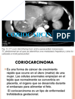 Co Rio Carcinoma