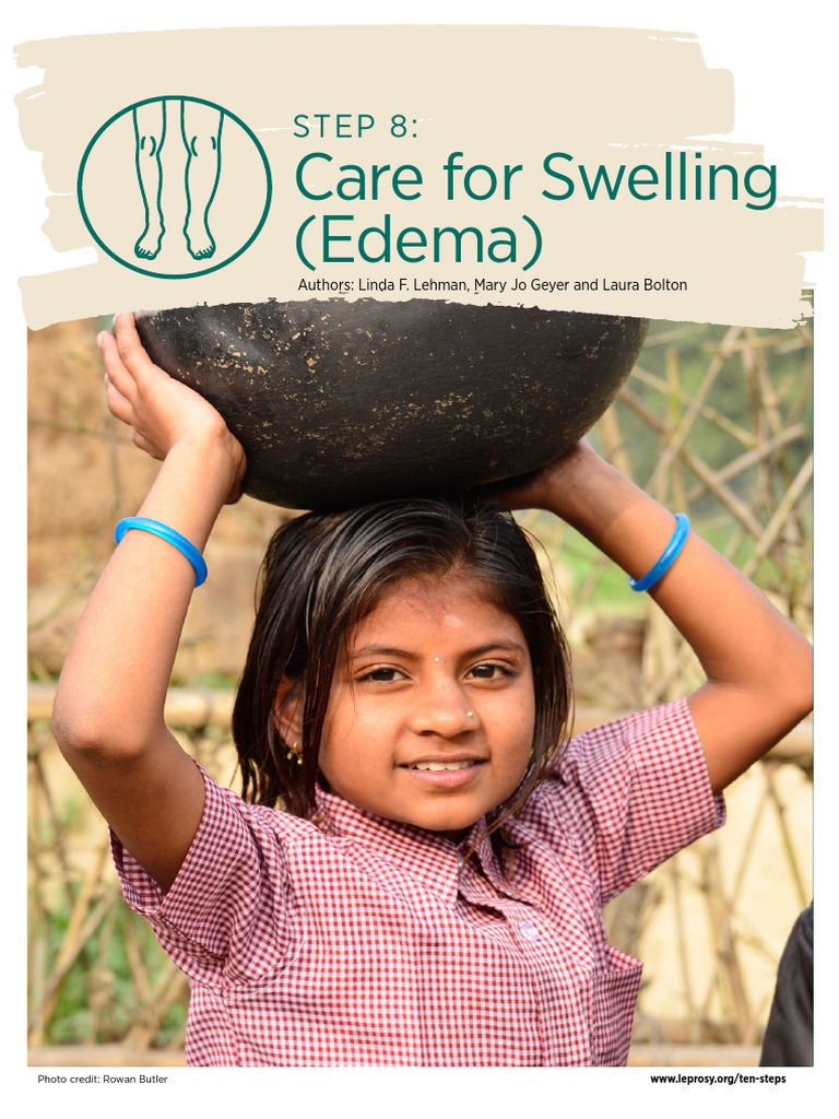 Care For Sweeling Oedeme | PDF | Edema | Medicine