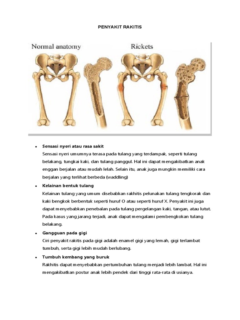 Ciri dan Pengobatan Penyakit Rakitis | PDF