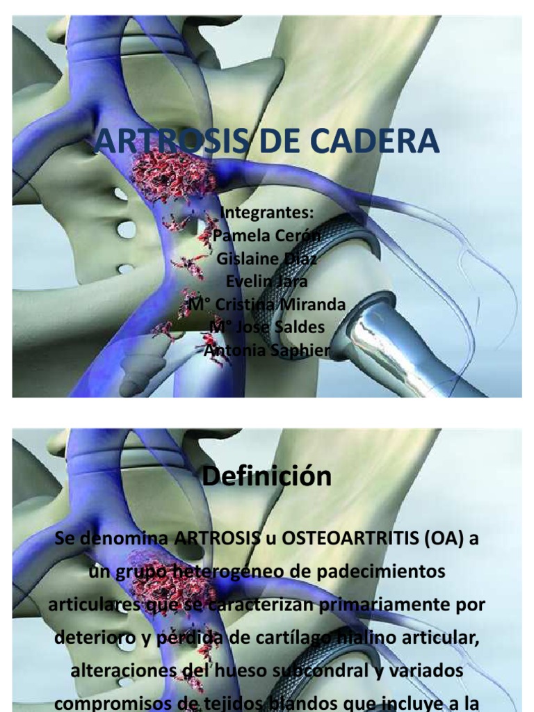 Artrosis de Cadera | PDF | Osteoartritis | Rodilla