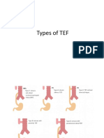 Types of TEF