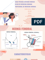 Hernia Femoral Crural - Grupo 1