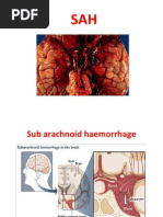 Download Subarachnoid Hemorrhage by Dr Kishore Kumar Ubrangala SN59810539 doc pdf