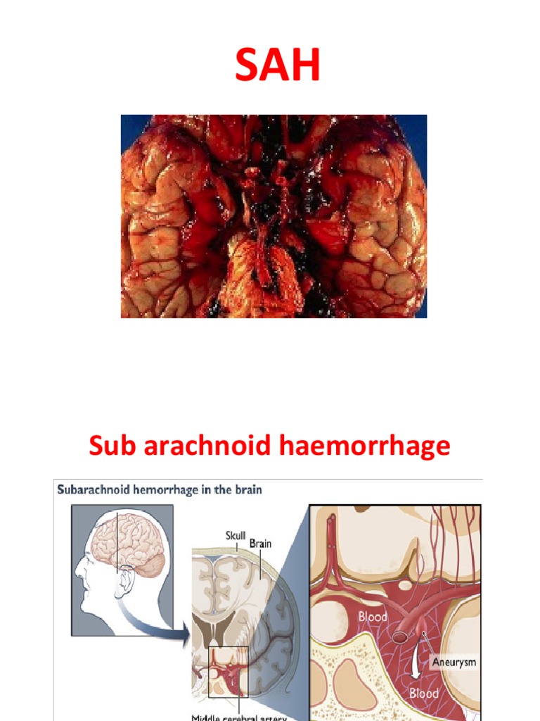 Subarachnoid Hemorrhage PDF Headache Clinical Medicine